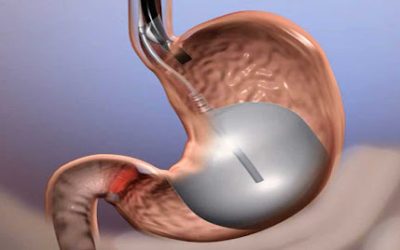 Gastric Balloon for Weight Loss