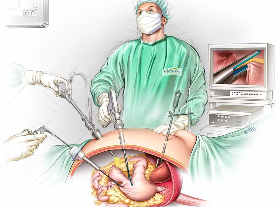 Gastric Sleeve Kenya